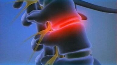 vertebral disklerin lomber osteokondroz ile sıkıştırılması