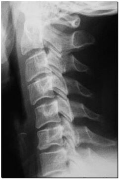Servikal omurganın röntgeni