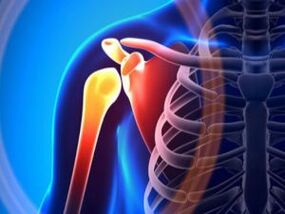 Artroz nedeniyle iltihaplı omuz eklemi - kas-iskelet sisteminin kronik bir hastalığı