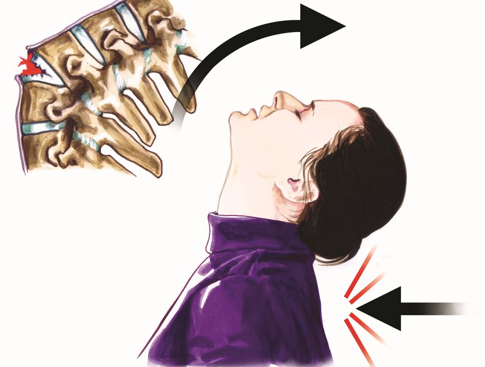 Boyun ağrısının bir nedeni olarak omurga hasarı